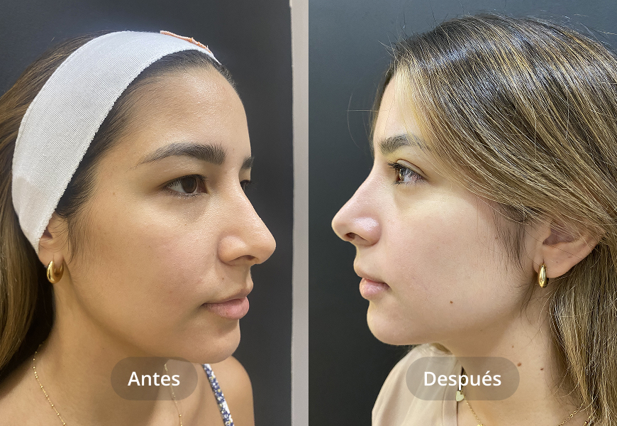 Blefaroplastia