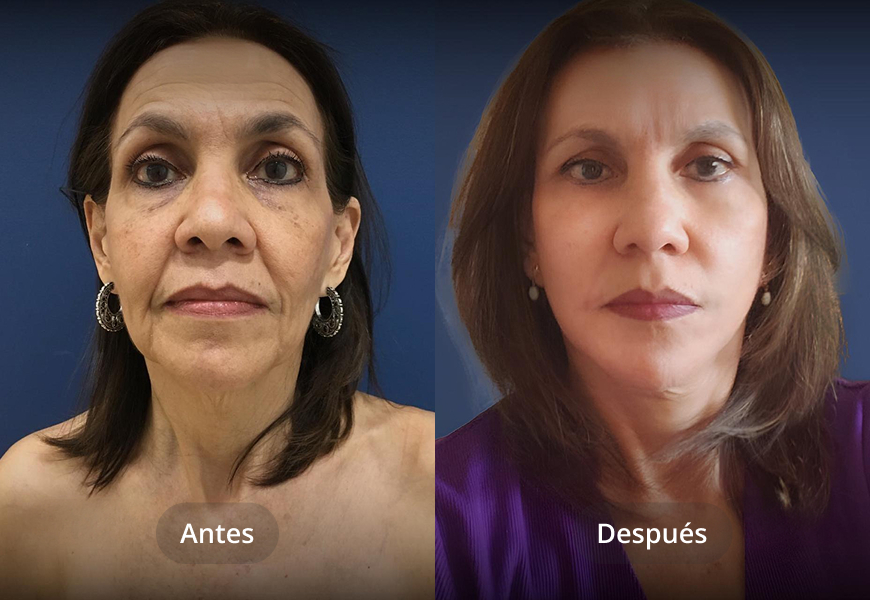Lifting facial