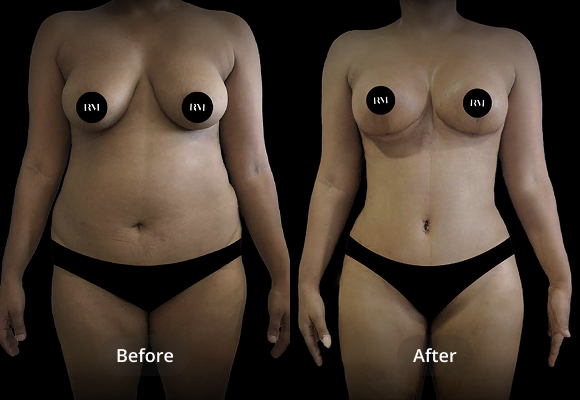 Abdominoplasty