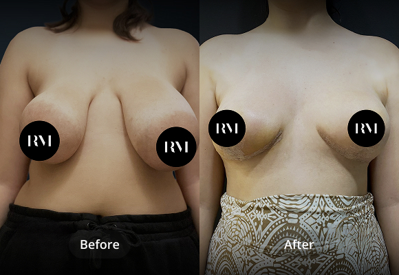 Breast Reduction