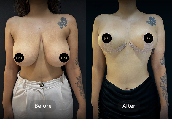 Breast Reduction